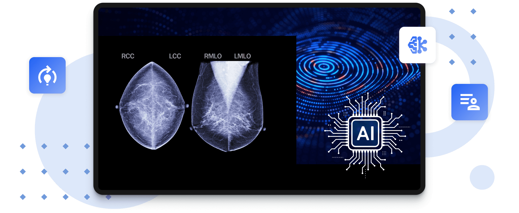 AI Driven Mammography Analytics